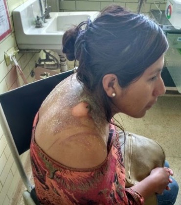 Mujer fue quemada con agua hervida por su pareja 