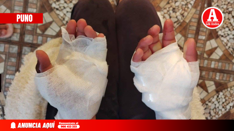 Niña quemada como castigo es trasladada de emergencia a hospital de Arequipa