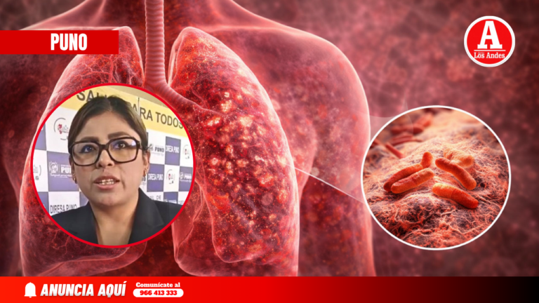 Puno: aumentan casos de tuberculosis y advierten retraso en diagnóstico