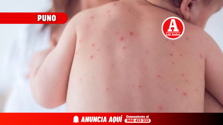 Confirman 35 casos de sarampión en la región Puno