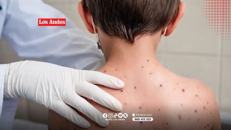 Casos de sarampión llegan a 680 confirmados