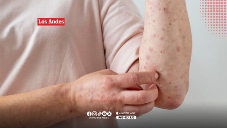 Junin: Alerta sanitaria por posible circulación de sarampión tras caso confirmado