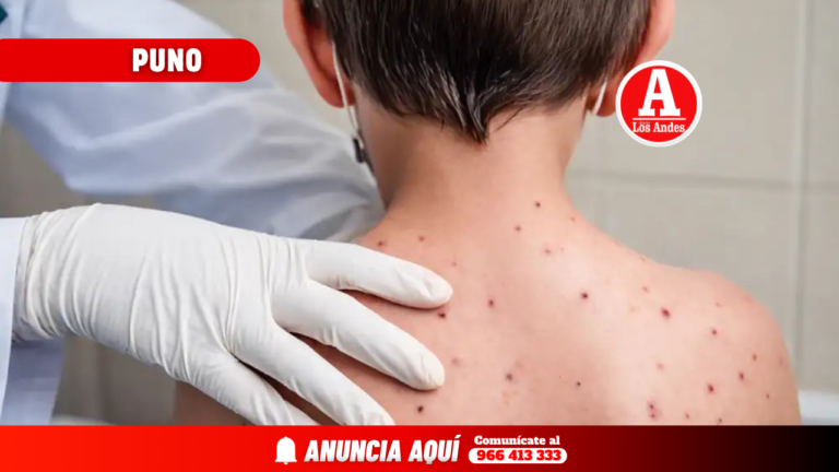 Sarampión supera los 600 casos en la región