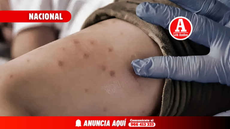 Autorizan transferencia por S/4 millones a regiones para atender casos de sarampión