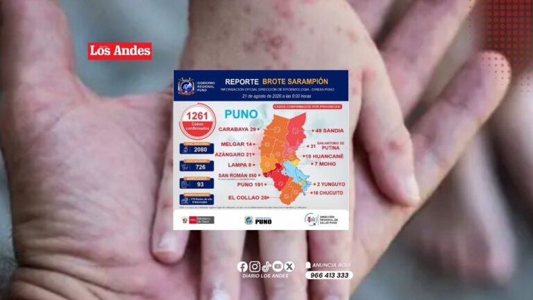 Sarampión en Puno registra 1261 casos confirmados y seis hospitalizados